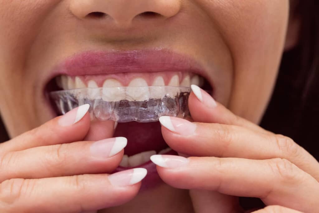 clear aligners rockhampton